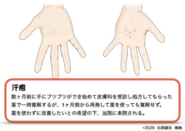 【治療日誌】汗疱(10)
