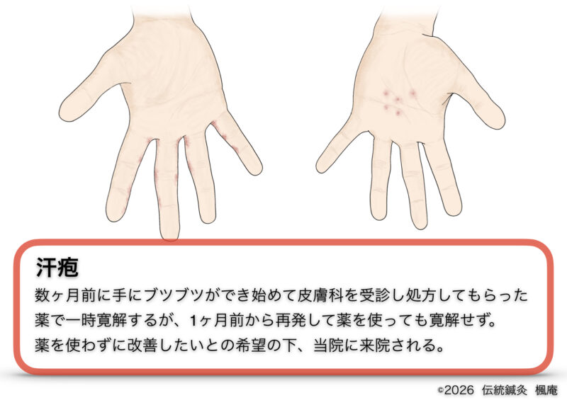【治療日誌】汗疱(10)