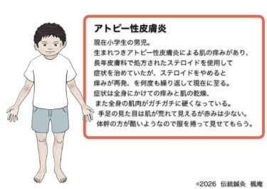 アトピー性皮膚炎